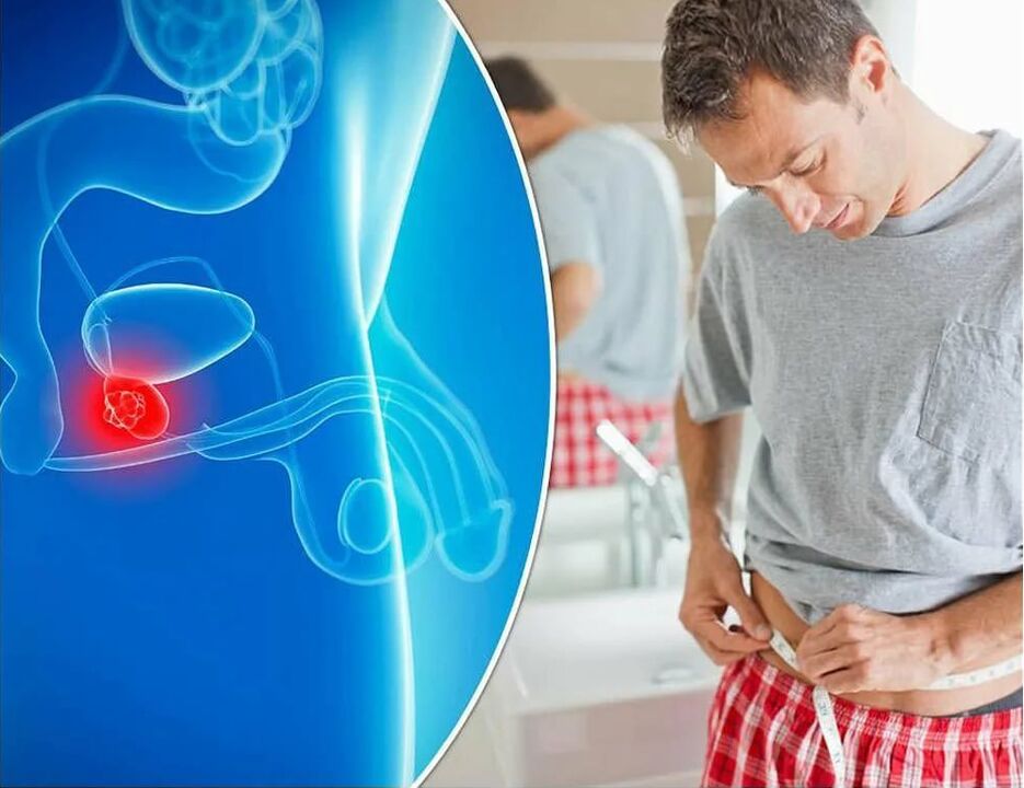 Symptoms and causes of prostate inflammation