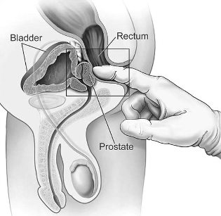 a prostatitis
