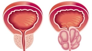 Reasons for the development of prostatitis and prostate adenoma